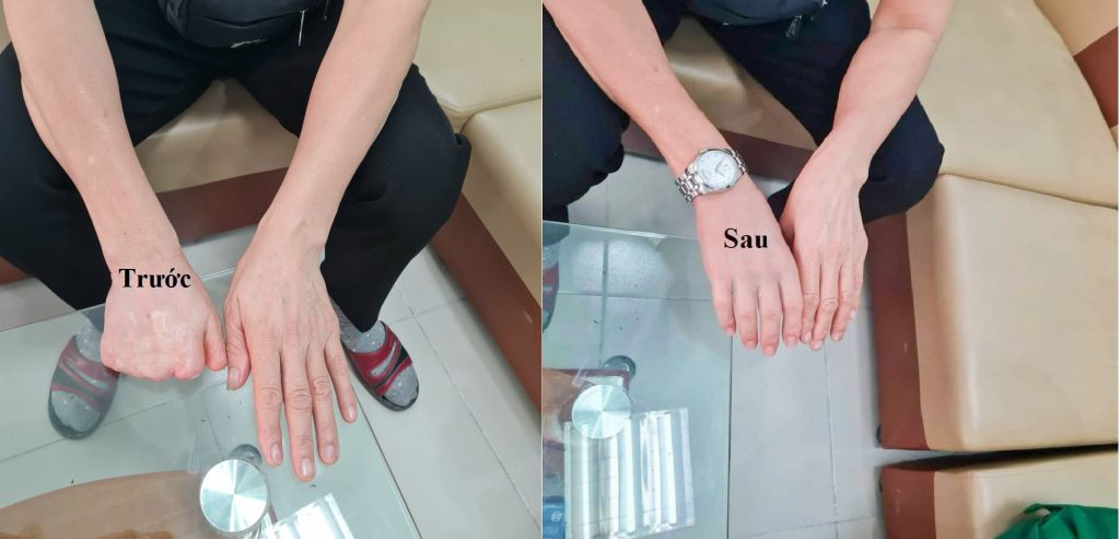Hình ảnh khách hàng bị mất 1 nửa bàn tay do tai nạn lao động.Sự thay đổi trước và sau khi lắp bàn tay giả