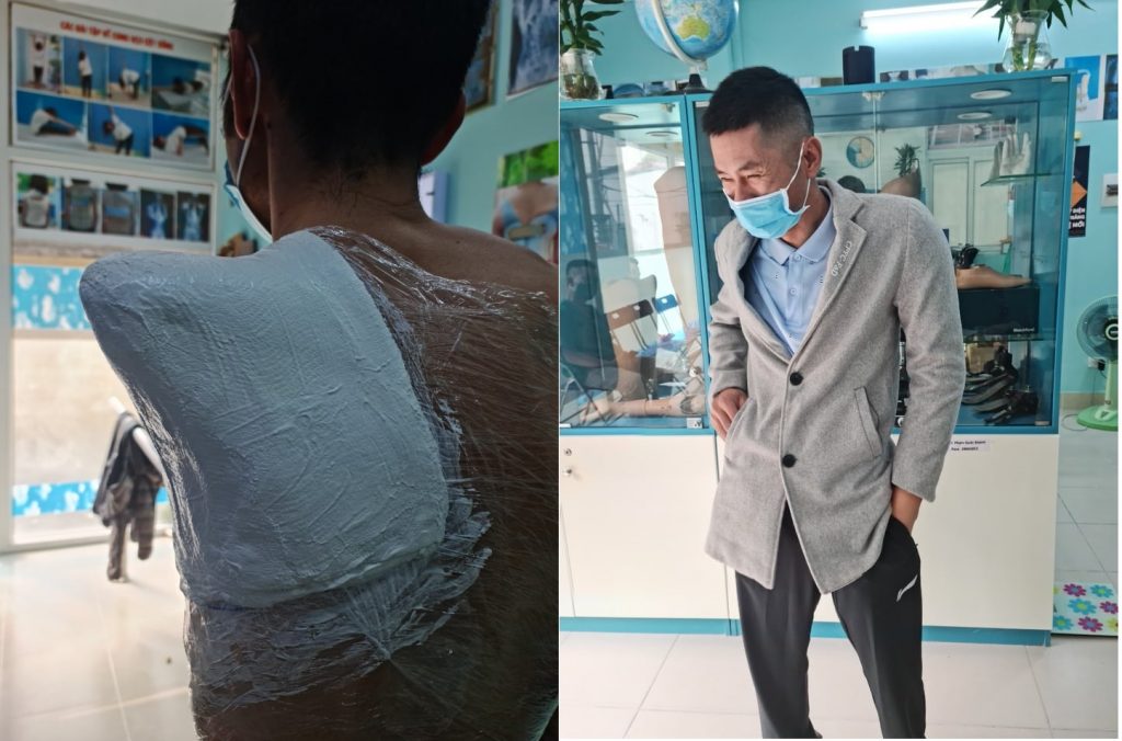 Khách hàng nam sử dụng tay giả thẩm mỹ tháo khớp vai ,thay đổi trước và sau khi sử dụng.