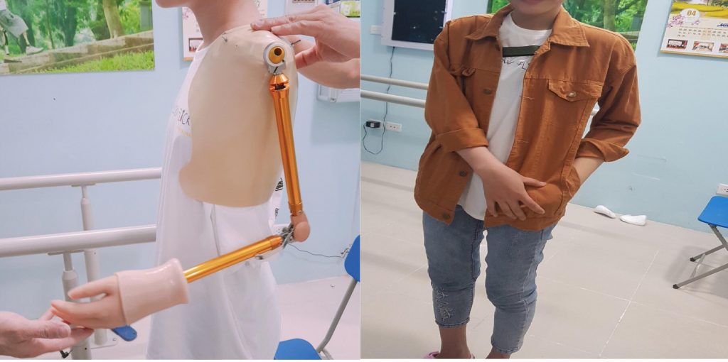 Khách hàng nam sử dụng tay giả thẩm mỹ tháo khớp vai ,thay đổi trước và sau khi sử dụng.