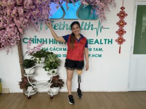 chị giang khách hàng sử dụng Chân giả trên gối
