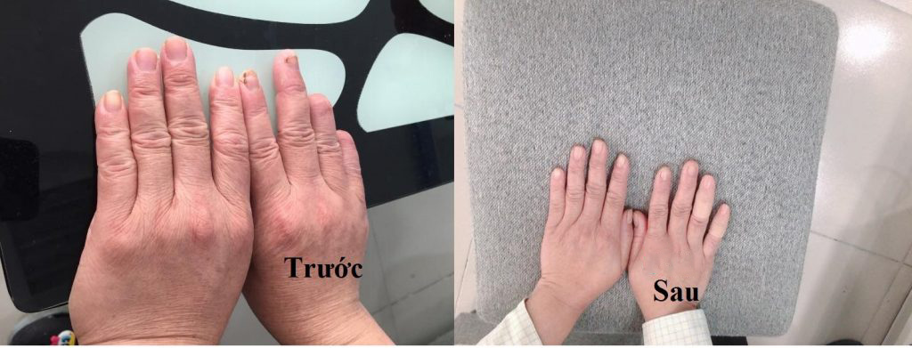 Hình ảnh khách hàng có sự khác biệt rõ rệt trước và sau khi đeo 2 ngón giả silicon:Ngón út và áp út tay phải.
