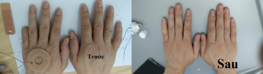 Hình ảnh ngón út được tạo hình bởi silicon và dễ dàng so sánh được sự khác biệt trước và sau khi lắp ngón tay giả thẩm mỹ.