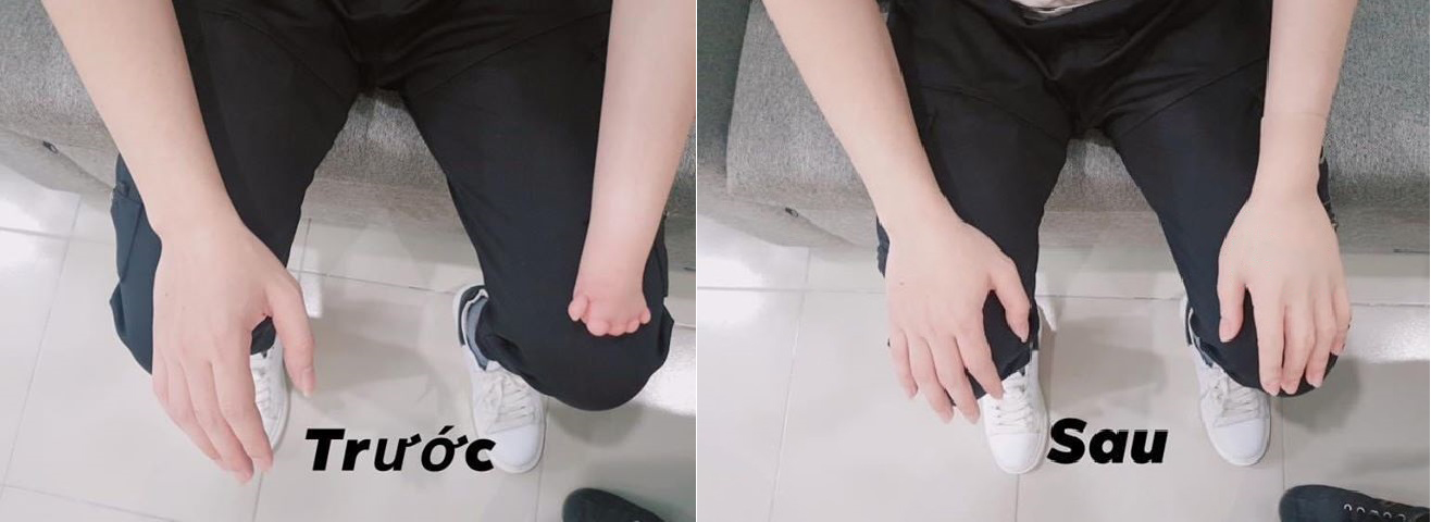 Hình minh họa một người khuyết tật bị mất 1 bàn tay ,trước và sau khi đeo bàn tay thẩm mỹ silicon có sự khác biệt rõ rệt.