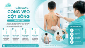 các dạng cong vẹo cột sống thường gặp