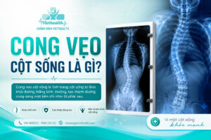 cong vẹo cột sống là gì - chỉnh hình viethealth