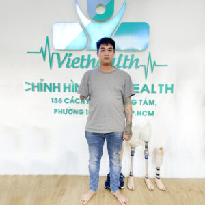 tay giả chức năng