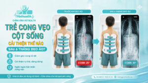 trẻ cong vẹo cột sống - áo chỉnh hình viethealth