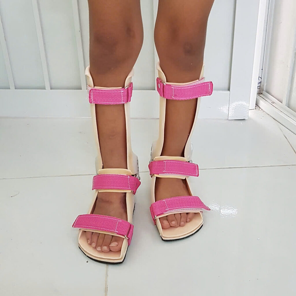 Nẹp chỉnh hình – Giải pháp phục hồi vận động an toàn và hiệu quả