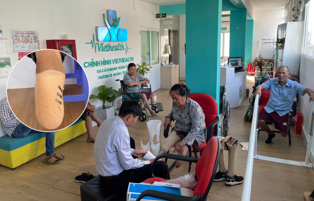 cắt chân bao lâu được lắp chân giả