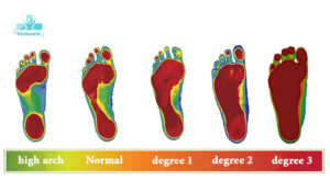 Mức độ bàn chân bẹt
