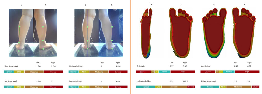 lót bàn chân bẹt - chỉnh hình viethealth