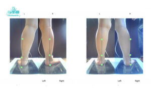 bàn chân bẹt và dấu hiệu nhận biết