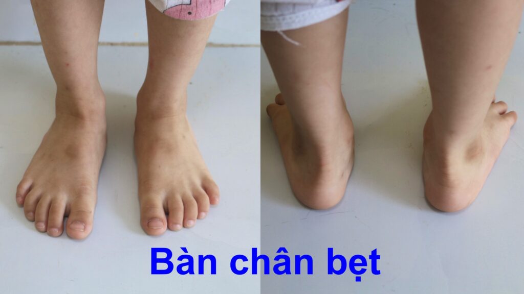 tại sao đưa bé đến viethealth khám bàn chân bẹt