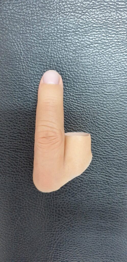 Ngón tay giả silicon- trường hợp mắt 1 ngón và 3 ngón