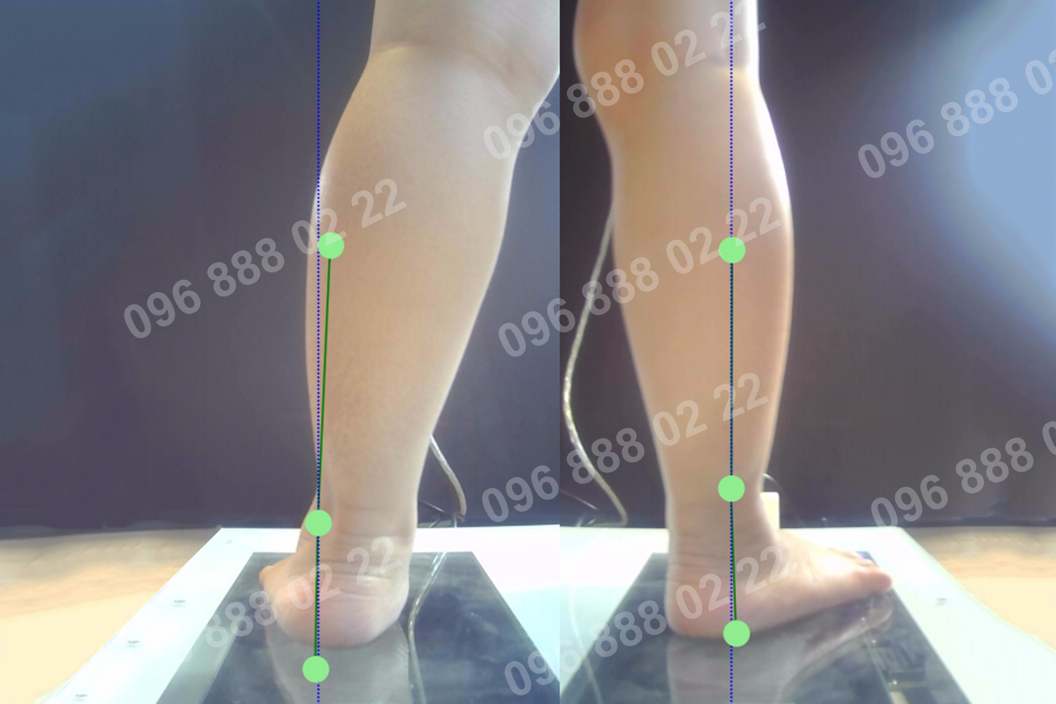 Bàn chân bẹt ở trẻ em - chỉnh hình Viethealth