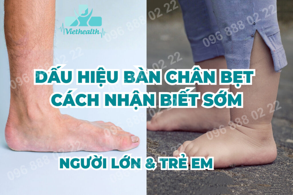 Dấu hiệu bàn chân bẹt cách nhận biết sớm