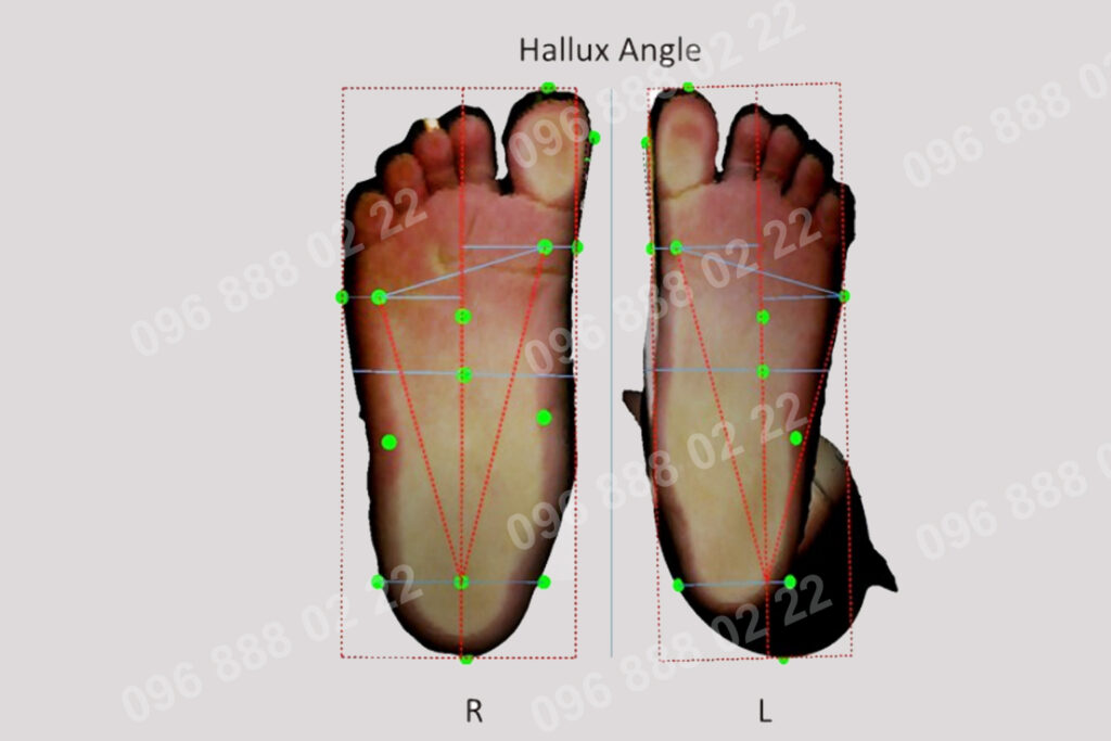 Dấu hiệu bàn chân bẹt ở trẻ em - chỉnh hình Viethealth
