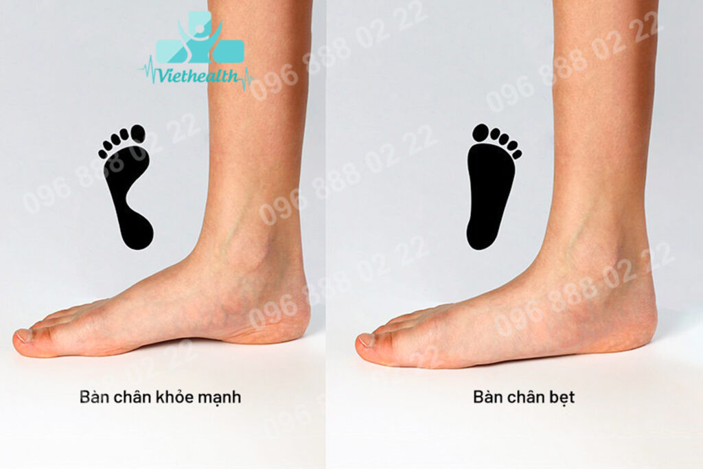 Dấu hiệu bàn chân bẹt ở trẻ em khi đứng