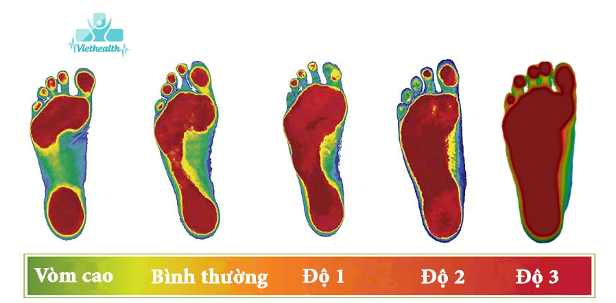 Mức độ bàn chân bẹt