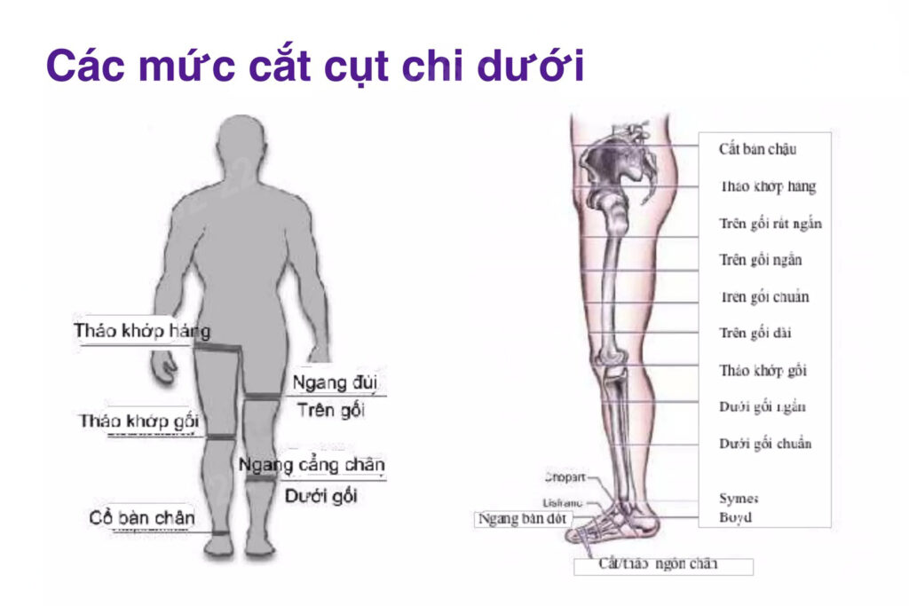các mức cắt cụt chân dưới