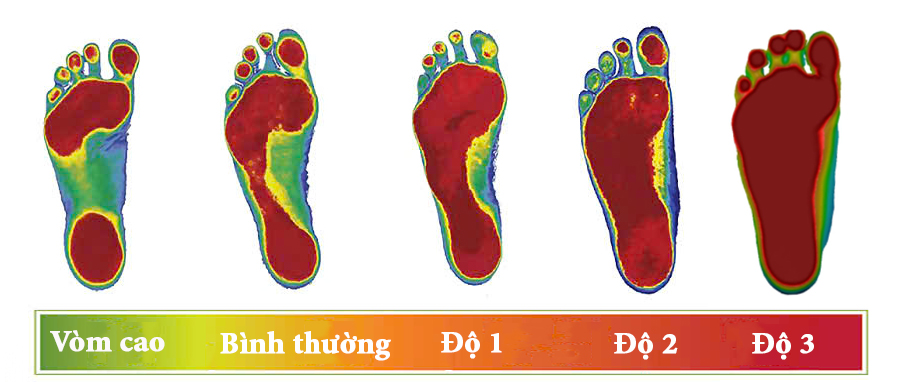 mức độ bàn chân bẹt