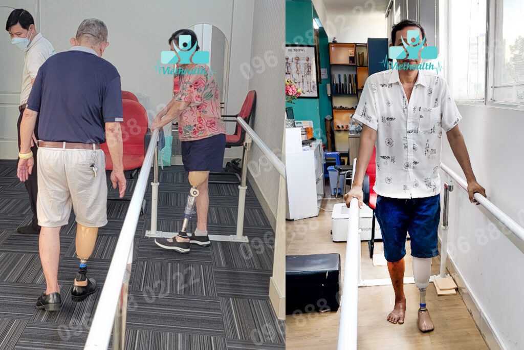 Bệnh nhân tập đi chân giả sau khi mỏn cụt lành