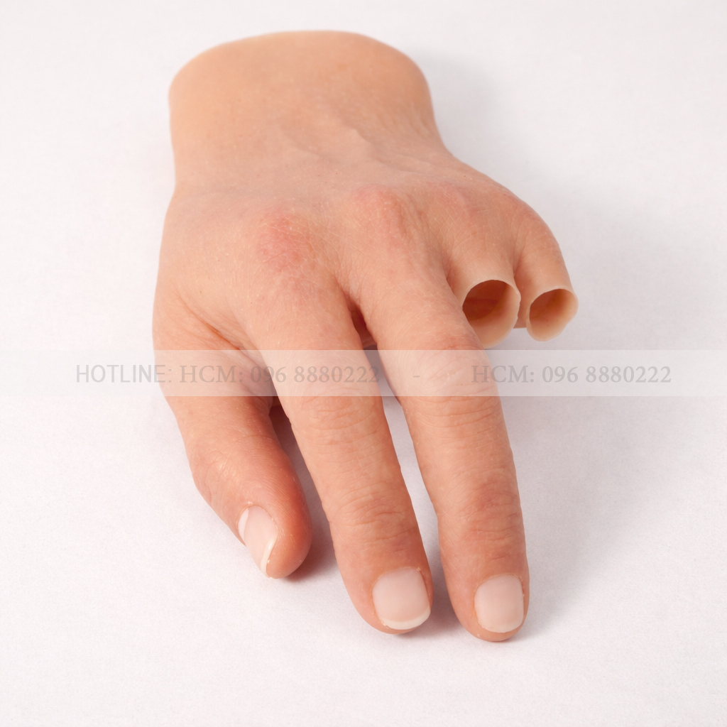 trường hợp mất 2 ngón tay