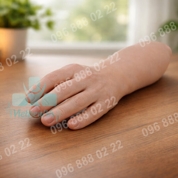 mất bàn tay khủy tay