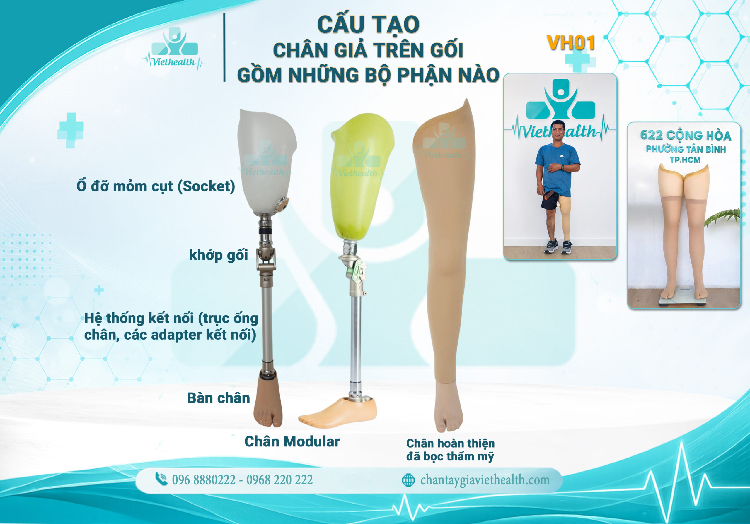 cấu tạo chân giả trên gối - viethealth
